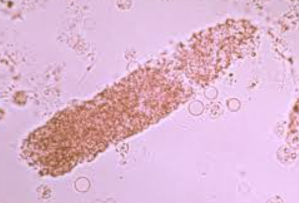 <p>Their presence should be considered when WBC CAST and many free WBCs and bacteria are seen in the sediment</p><ul><li><p>“Pyelonephritis”</p></li><li><p>Similar to granular cast</p></li></ul><p></p>