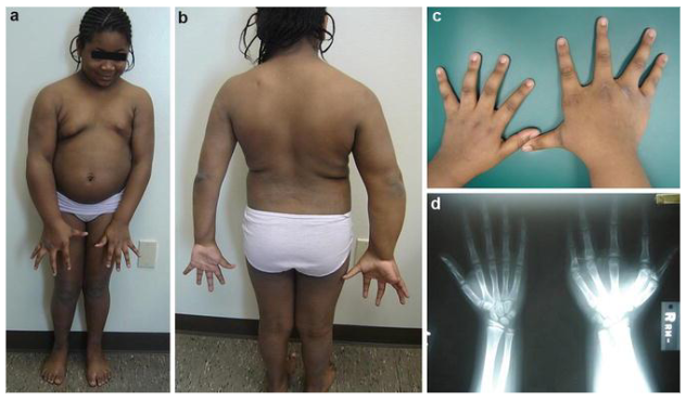 <p>one half of body is larger than the other half—congenital abnormalities<br>– associated w wilms tumor</p>