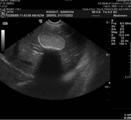 <p>Acoustic Shadowing</p>
