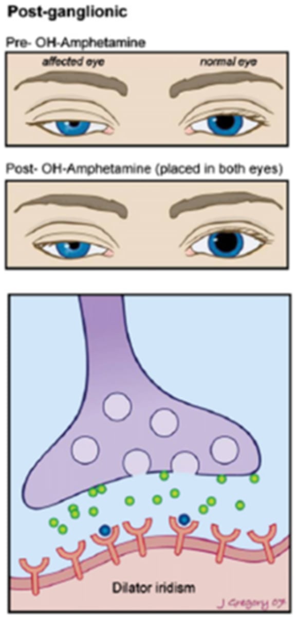 <p>very little NE = hydroxyamphetamine cannot force NE into the NMJ = pupil does NOT dilate</p>