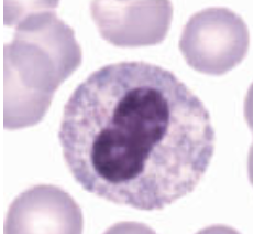 <p>which state of pelger huet anomaly&nbsp;refers to the following:</p><ul><li><p>nucleus is round or oval</p></li><li><p>no segmentation</p></li></ul><p></p>