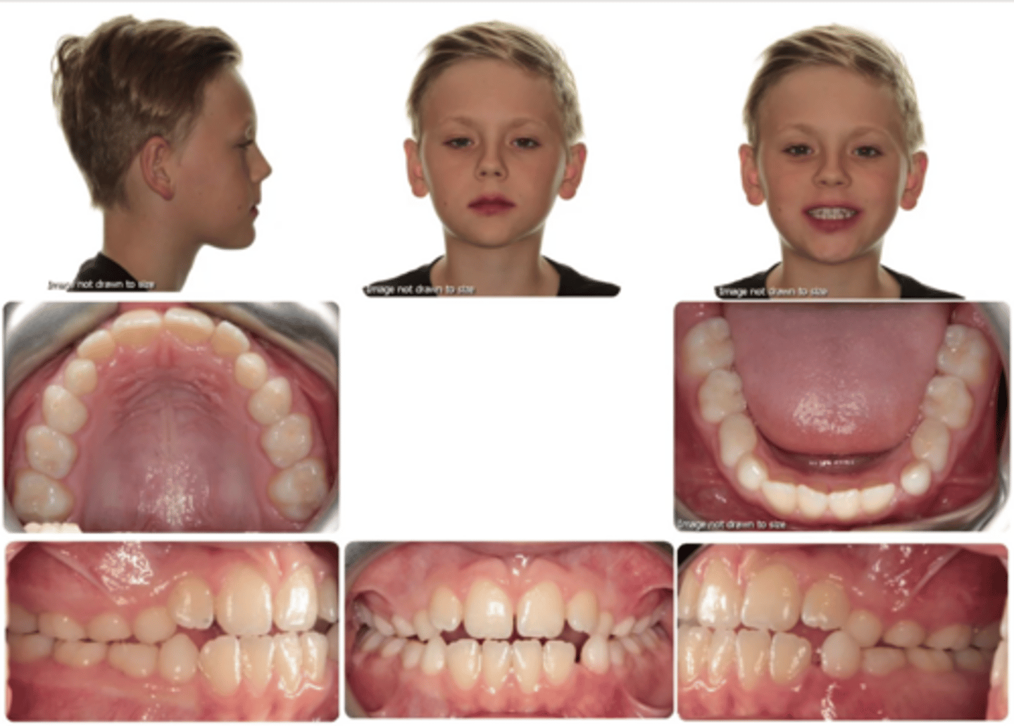 <p>What terminal plane does this patient have, and what kind of malocclusion will it become?</p>