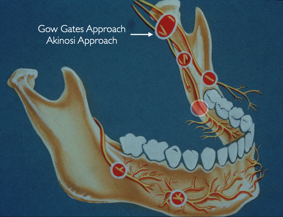 <p>because the injection site is a lot higher up on the mandibular nerve, it is able to anesthetize more branches/more of the mandibular nerve than your standard with a singular injection</p>