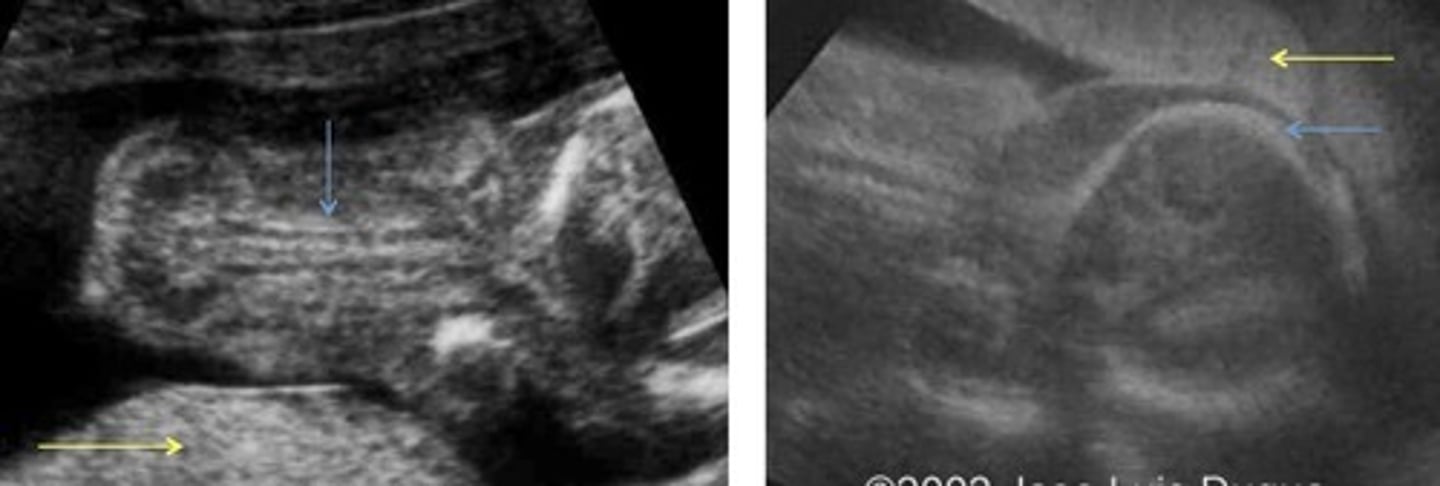 <p>Bone hypomineralization - deceased/absent ossification of spine/skull</p><p>Lethal</p><p>Narrow thorax and ribs</p>