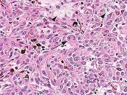 <p>Uveal malignant melanoma<br>N/E: Dom-shaped pigmented mass. M/P: The epithelioid variant  Larger irregular pleomorphic cells with larger nuclei and abundant acidophilic cytoplasm; that may contain melanin pigment.</p>