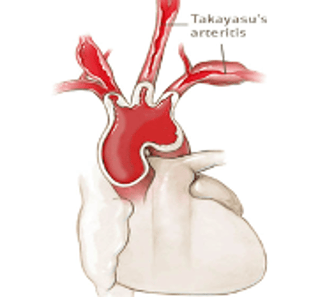 <p>stress cardiomyopathy: preceded by an intense emotional, physical or psychologic stress causing ballooning of the left ventricle. Can be caused by excessive coronary vasoconstriction or increase catecholamine release.</p>