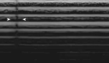 <ul><li><p><span style="background-color: transparent;">Piezoelectric crystals may become damaged or breaks in wiring can occur</span></p></li><li><p><span style="background-color: transparent;">Displayed as anechoic vertical lines</span></p></li><li><p><span style="background-color: transparent;">To confirm:</span></p><ul><li><p><span style="background-color: transparent;">Use more gel</span></p></li><li><p><span style="background-color: transparent;">Change approach</span></p></li><li><p><span style="background-color: transparent;">Use on various patients</span></p></li><li><p><span style="background-color: transparent;">Confirmed if still appears in exact location</span></p></li></ul></li></ul><p></p>