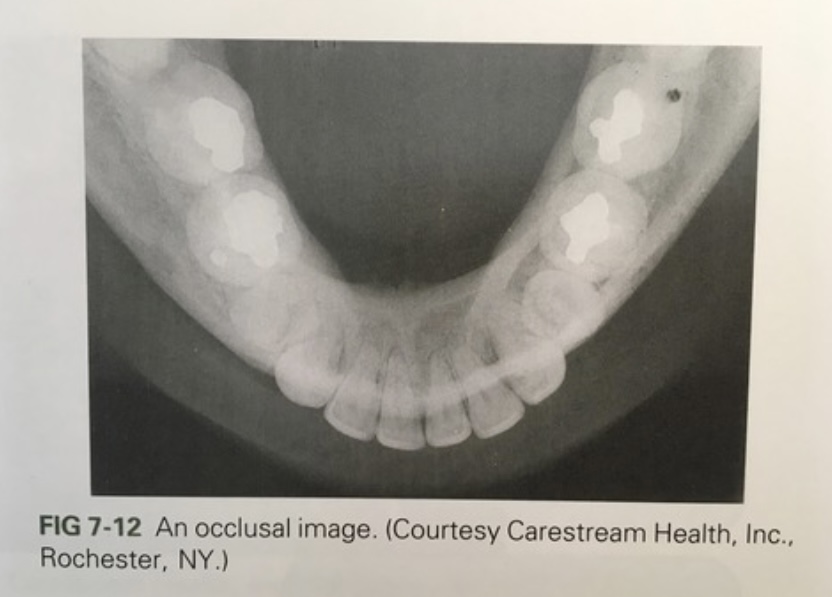 <p>occlusal radiographs</p>