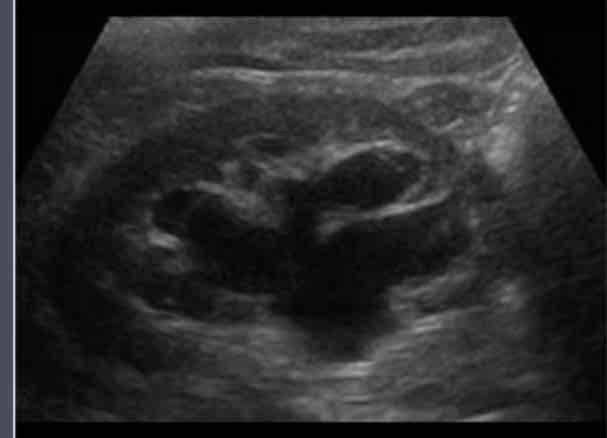 <p>What type of renal cyst is this? <span>– cortical cysts that bulge into the central sinus of the kidney</span></p>