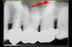 <p>x ray beam was directed below the zygoma</p>