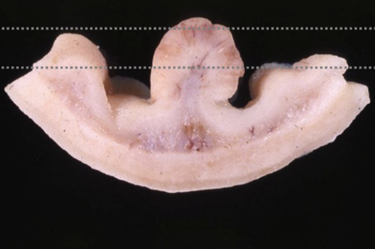 <p>What kind of tumor is this?</p>