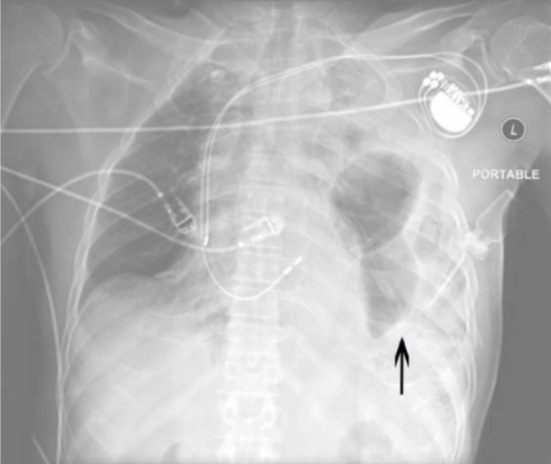 <p>Diaphragmatic Rupture</p>