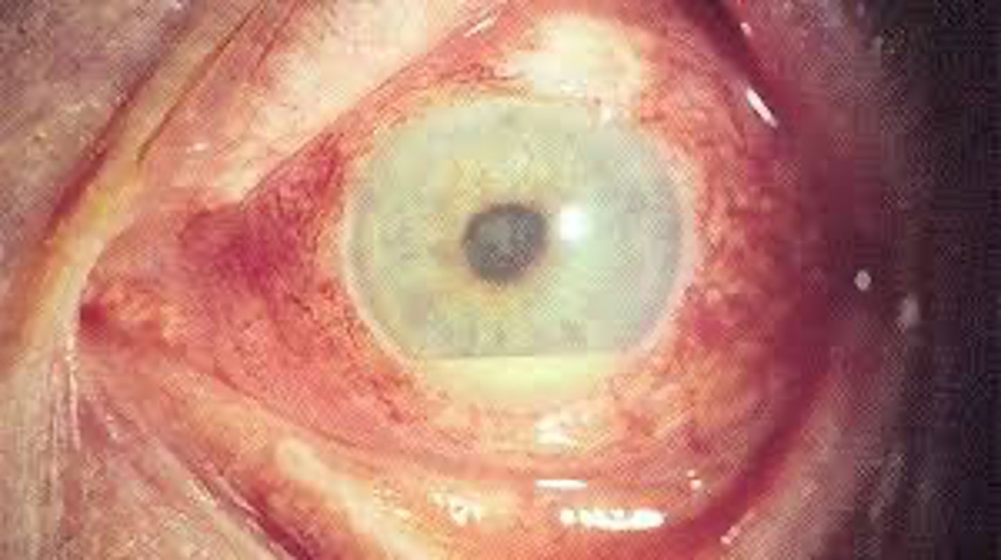 <p>A patient presents with recurrent painful oral ulcers, genitial ulcers, and eye inflammation. What is the MOST likely diagnosis?</p>