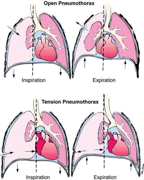 <p>open pneumothorax </p>
