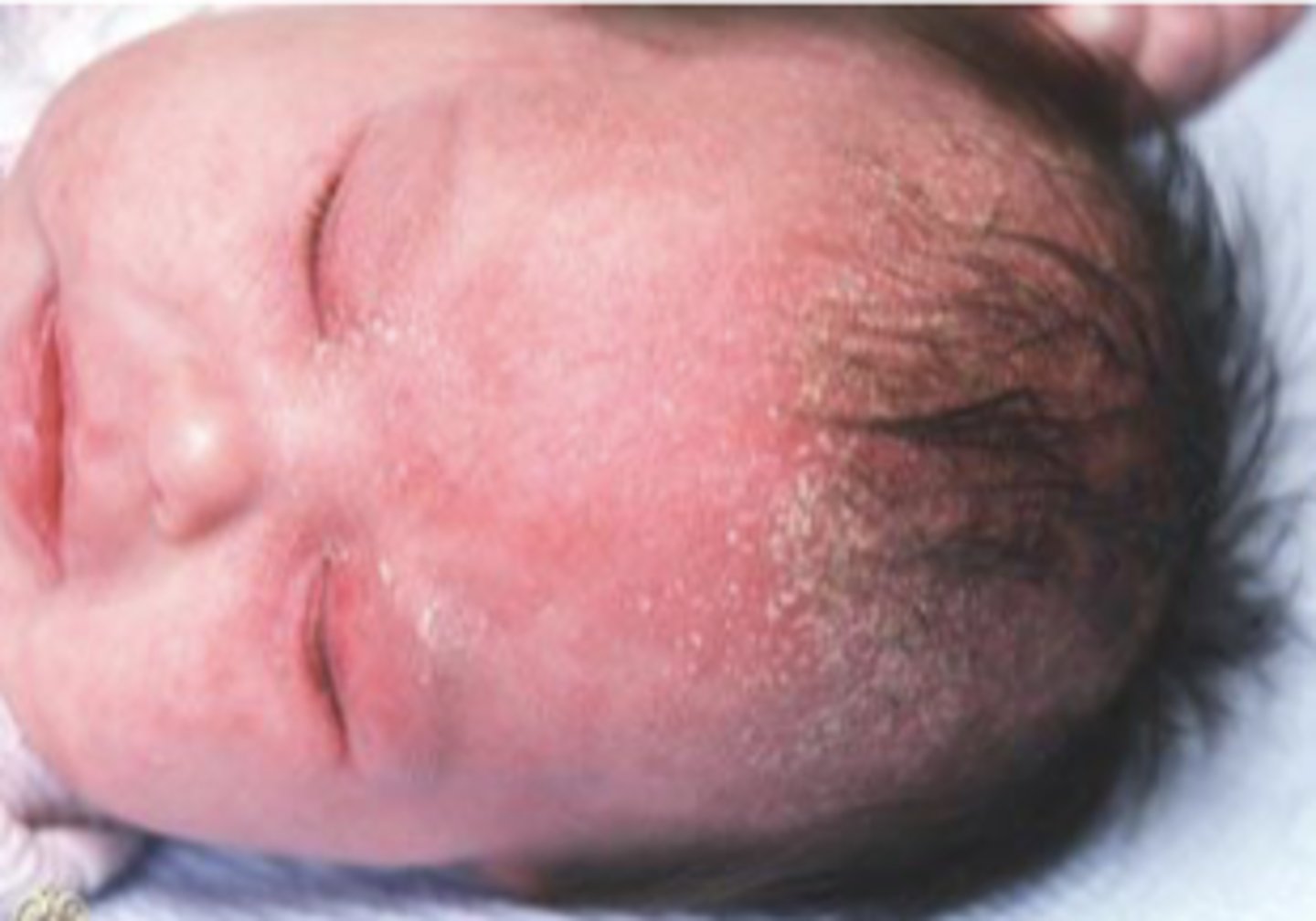 <p>dry, platelike sheet of keratin</p>