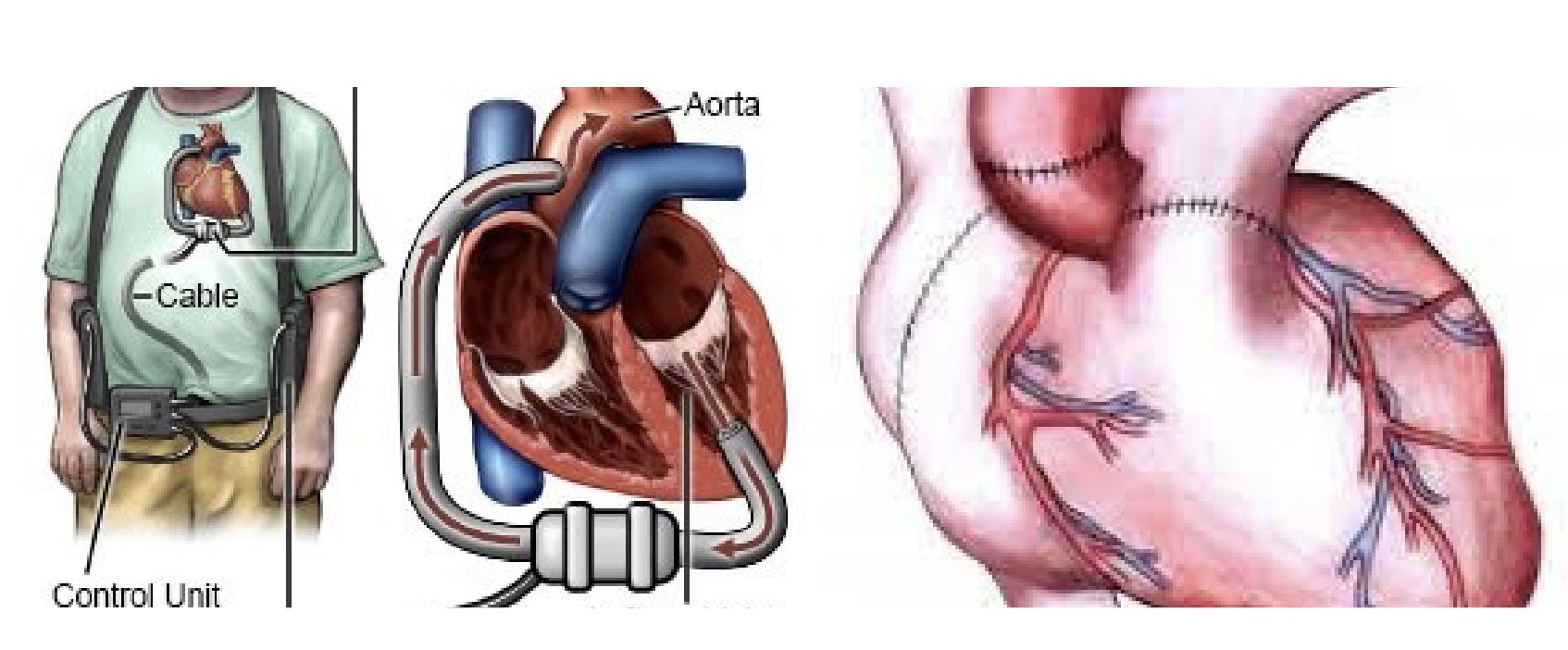<p><u>Ventricular Assist Device</u></p><p>-bridge to transplant; higher Q; bypasses heart as pump</p><p>-now smaller and battery run, but make sure battery doesn’t run out!</p><p>-can adjust the pump rate</p><p>-Exercise Rx complicated bc based on the pump</p><p><u>Heart Transplant</u></p><p>-no longer have NS intervention (no response SNS and PSNS)</p><p>-HR response really different</p>