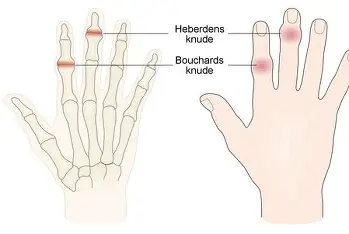 <ul><li><p><span style="background-color: transparent; font-family: "Times New Roman", serif;"><span>DIP-leder → Typiska vid knutor (Heberdens knutor). Vanligt vid primär artros.</span></span></p></li><li><p><span style="background-color: transparent; font-family: "Times New Roman", serif;"><span>Tummmen (CMC1-leden)&nbsp;</span></span></p></li></ul><p></p>