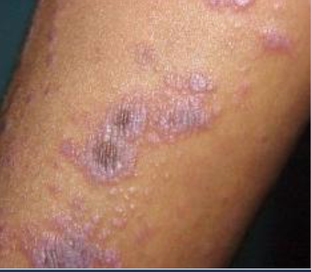 <p>what are these purple puritis, polygonal papules </p>