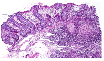 <p>what disease is this the histology of?</p>