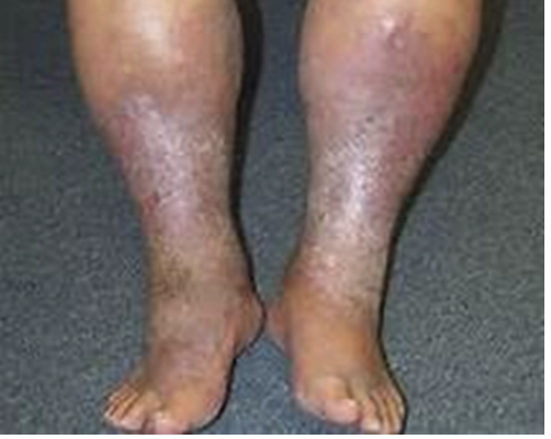 <p><span>How would you document the condition of this patient’s skin?</span></p><p></p>