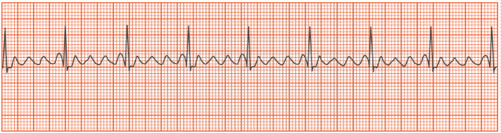 <p>Which of the following rhythms is shown in the strip above?</p><p></p><p>A. Premature atrial complex</p><p>B. Atrial tachycardia</p><p>C. Atrial flutter</p><p>D. Atrial fibrillation</p>