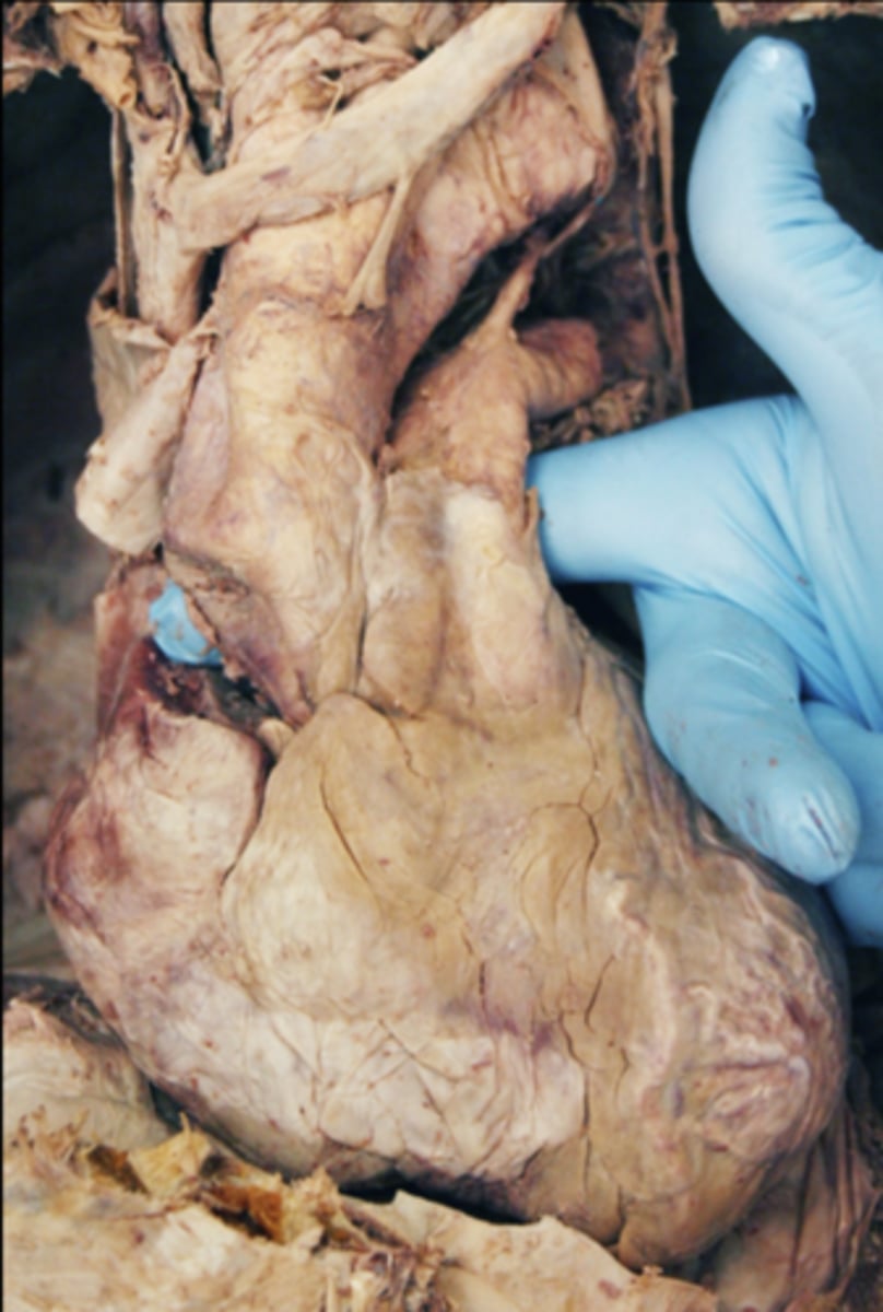 <p>behind great vessels (aorta and pulmonary trunk)</p>