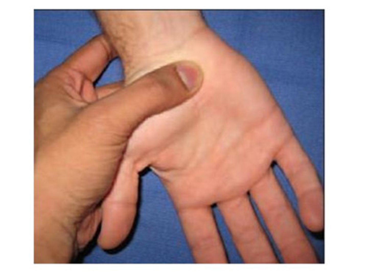 <p>pressure over median nerve in carpal tunnel</p>