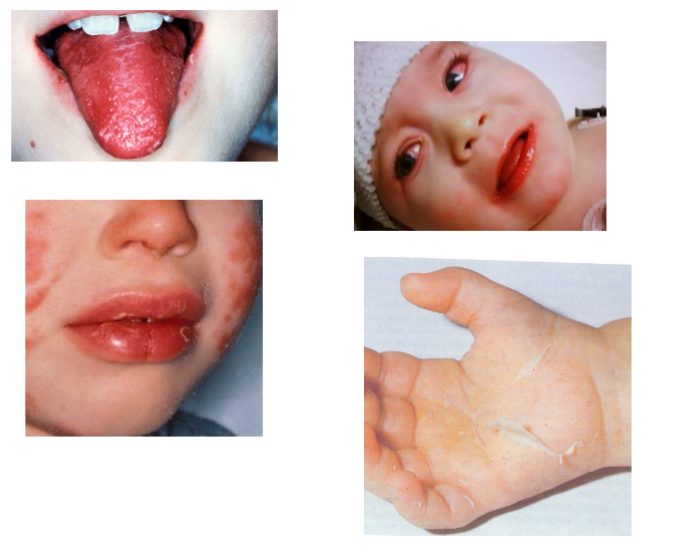 <p>conjunctivitis, rash, adenopathy (enlarged cervical lymph nodes), strawberry tongue (erythematous mouth and throat and dry cracked lips), hands (edema and erythema with peeling skin on palms), fever (high fever for 5 or more days in kids less than 5 years)</p><p>CRASH- burn</p>