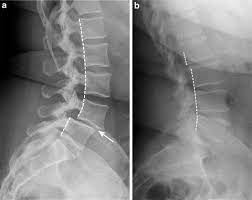 <p>forward displacement of one vertebra on another. Causes chronic back pain. May be caused by spondylolysis.</p>