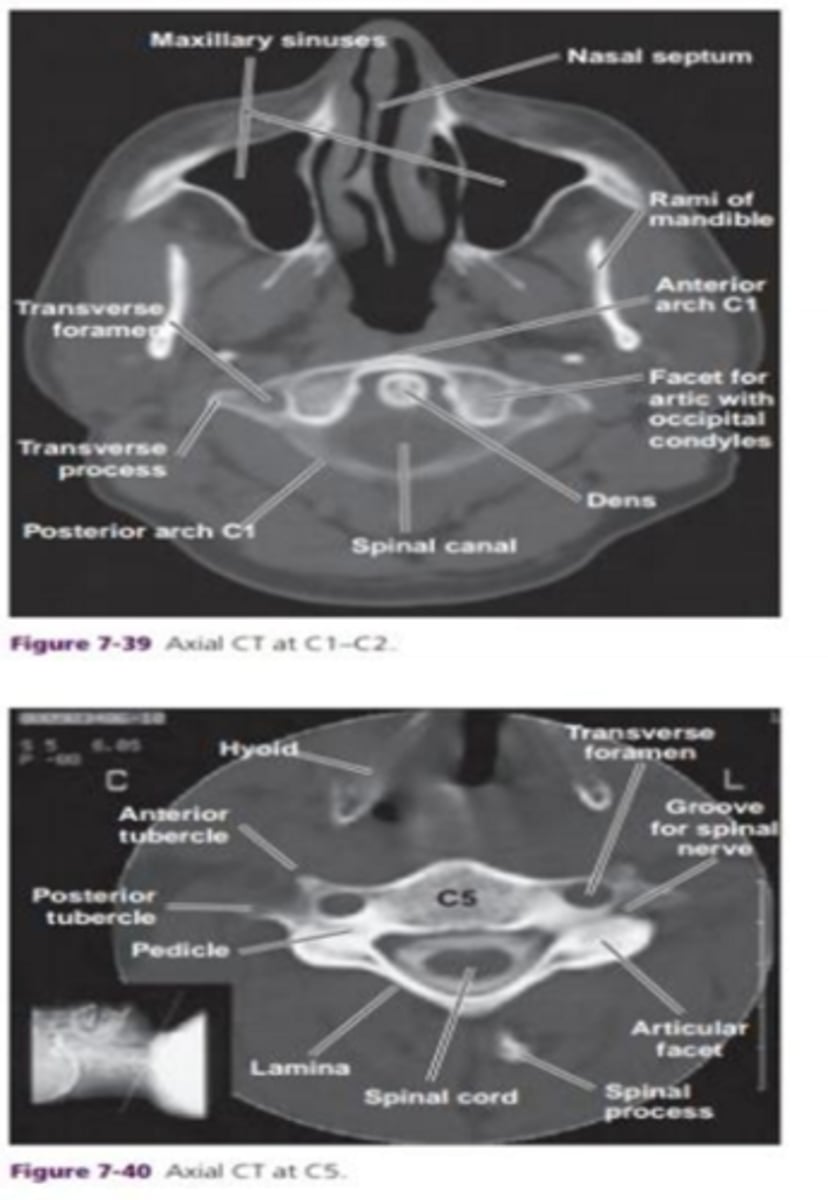 <p>What should you note about the dens? and the spinal canal?</p>