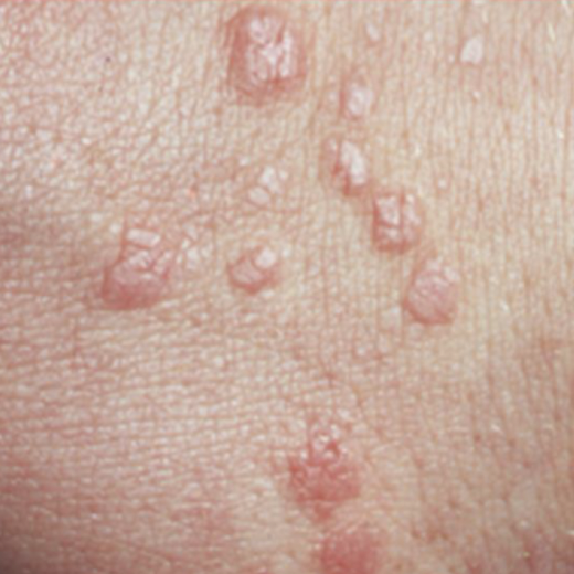 <p>small solid, elevated lesion which projects above the plane of surrounding skin</p>