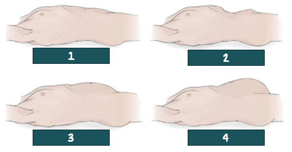 <p>2? Is the normal or abnormal?</p>