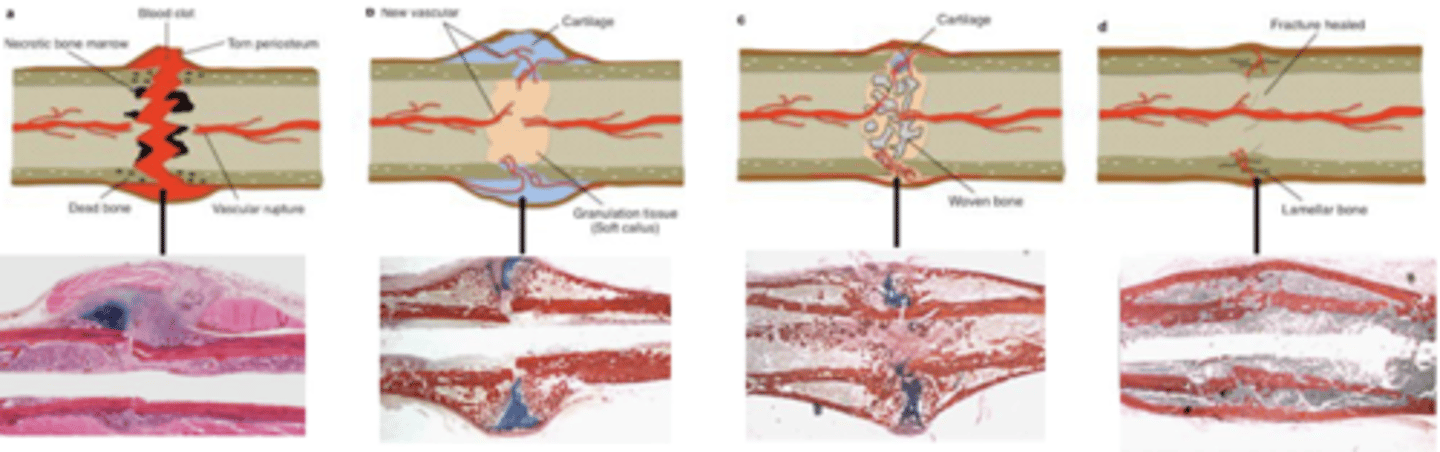 <p>1. Blood clot formation (early stabilisation, immune cell infiltration-granulation tissue)</p><p>2. soft callus formation (stabilisation but some movement, cartilage (soft) callus replaces blood clot)</p><p>3. Hard callus formation (Bridged/union, vascularisation of callus, cartilage callus replaced with woven bone)</p><p>4. Hard callus remodelling (osteoclasts remodel woven bone into mature cortical bone, return to original shape)</p>