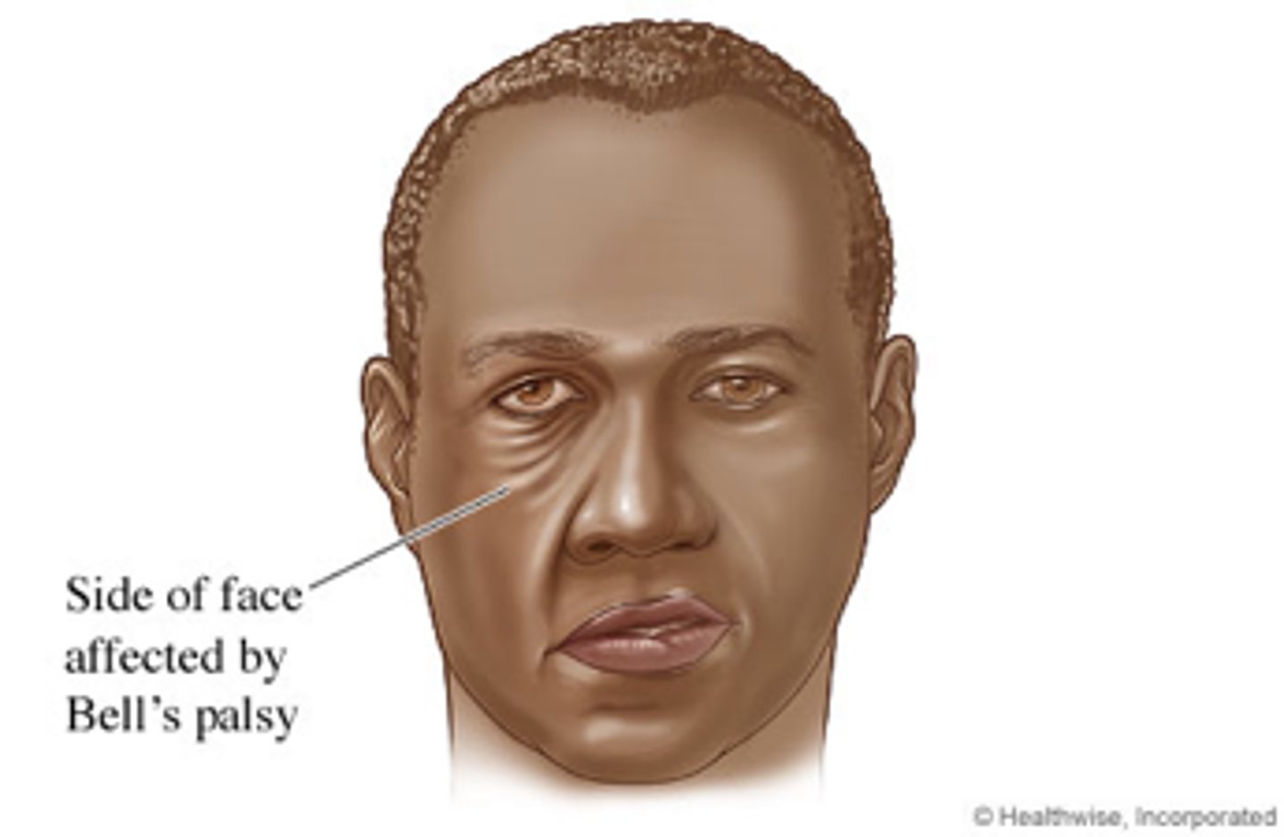 <p>-paralysis of facial muscles &amp; taste on 1 side of afce<br>-caused by inflamed CN VII (facial)</p>