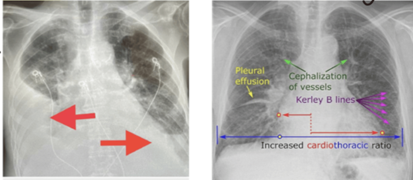 <p>- release of aldosterone through RAAS stimulations leads to fluid retention - progressing to fluid overload</p><p>- in left sided backlog of blood seeps out entering lungs due to fluid retention (pulmonary oedema)</p><p>- in right sided fluid leaks which increases blood volume and accumulates in peripheral circulation - causing raised JVP and peripheral oedema</p>