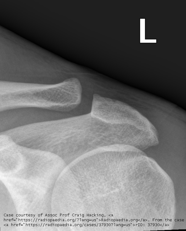 <p>AP left AC joint (without weights).</p>