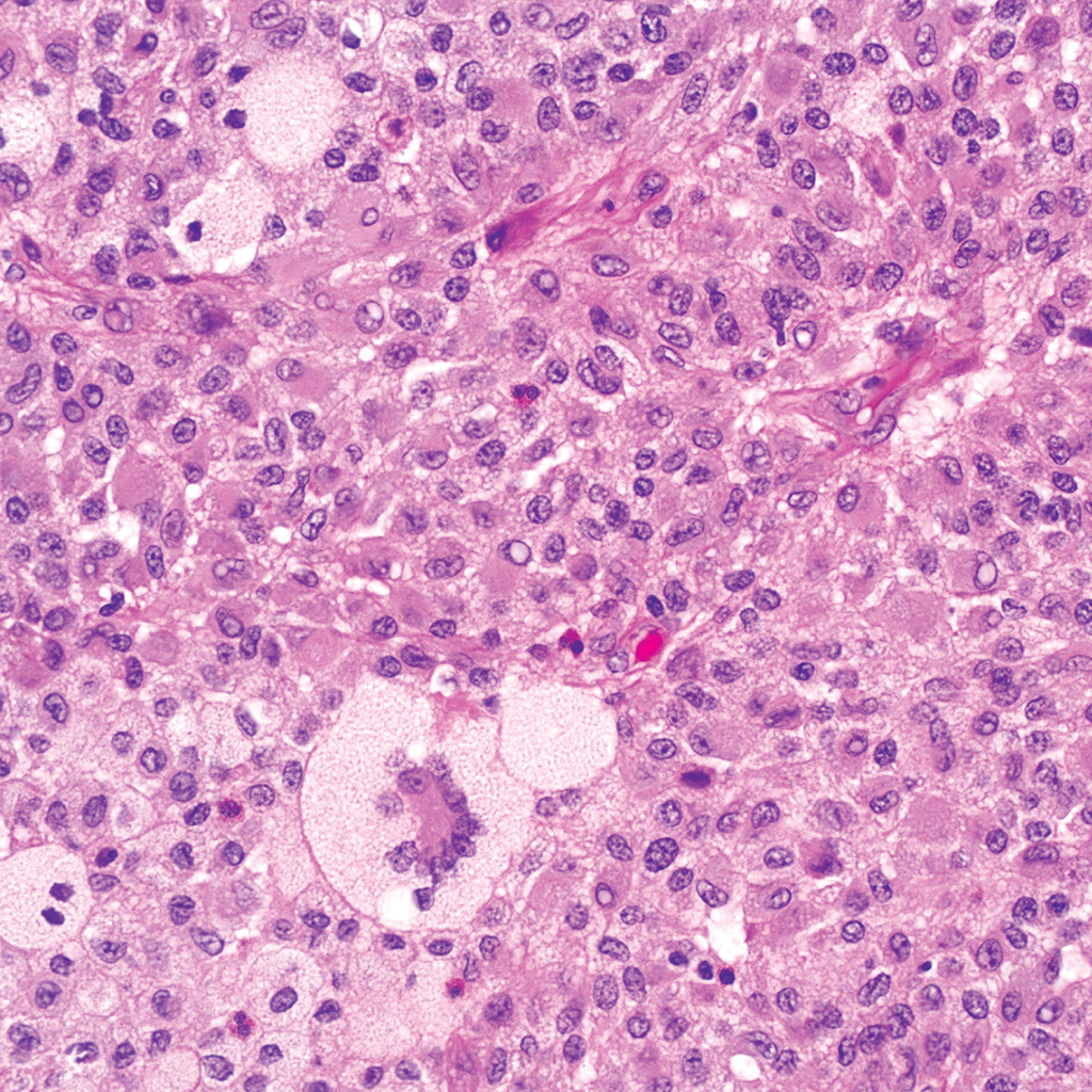 <p>Patient de 10 ans avec masse dermique</p><p>1) Diagnostic</p><p>2) Localisation, epidémiologie</p><p>3) Histo</p><p>4) IHC</p><p>5) Moléculaire</p><p>6) DD</p>