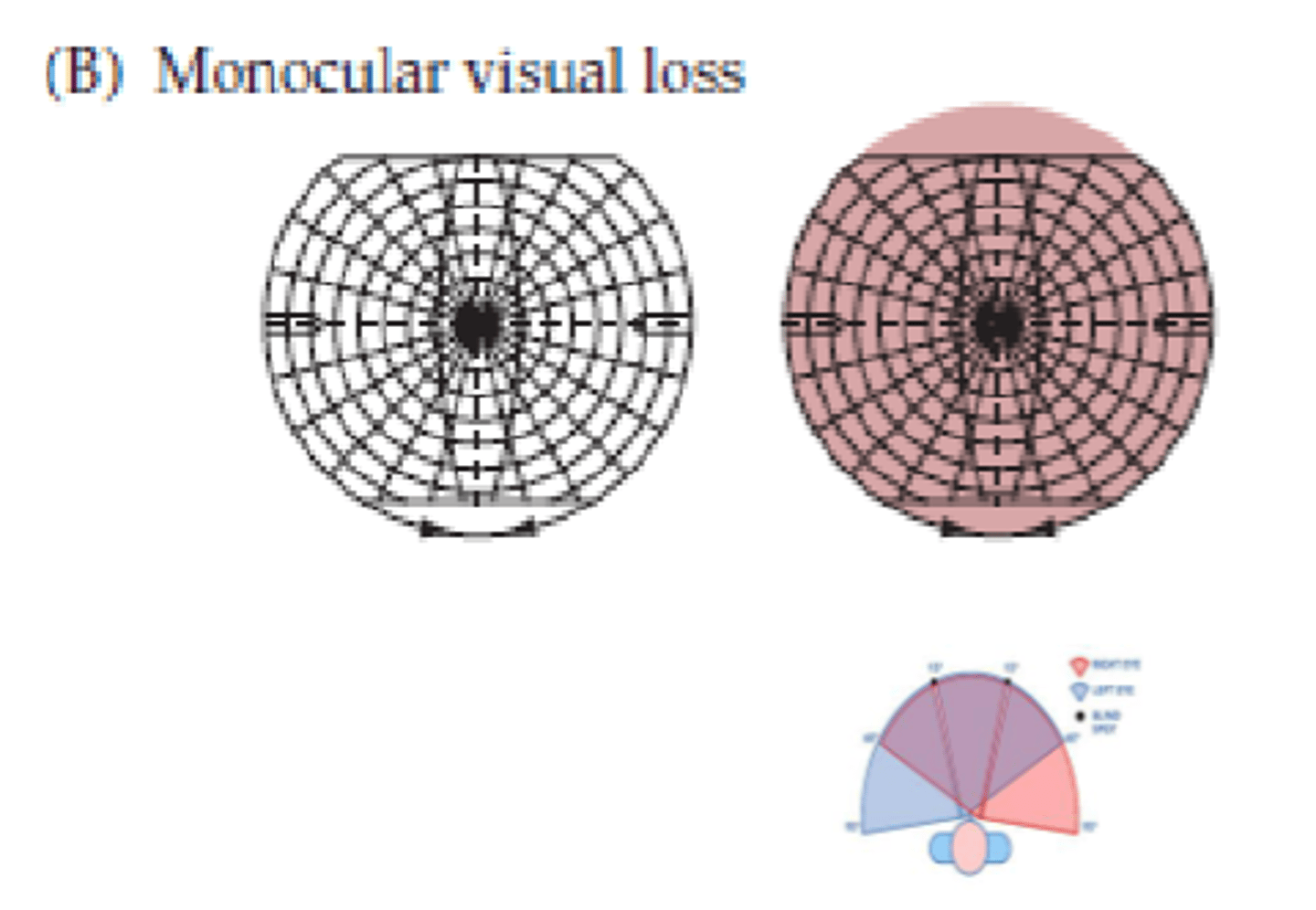 <p>Monocular visual loss</p>