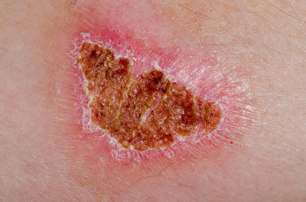 <ul><li><p>Partial-thickness burn</p></li><li><p>Epidermis + superficial part of dermis is damage</p></li><li><p>Skin is red, painful, blisters (can regrow epidermis)</p></li></ul><p></p>