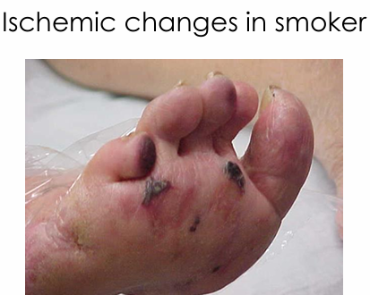 <ul><li><p>Vascular surgery referral</p></li><li><p>Management of infection and/or inflammation</p></li><li><p>Pain control</p></li><li><p>Smoking cessation</p></li><li><p>Glycemic control</p></li></ul><p></p>