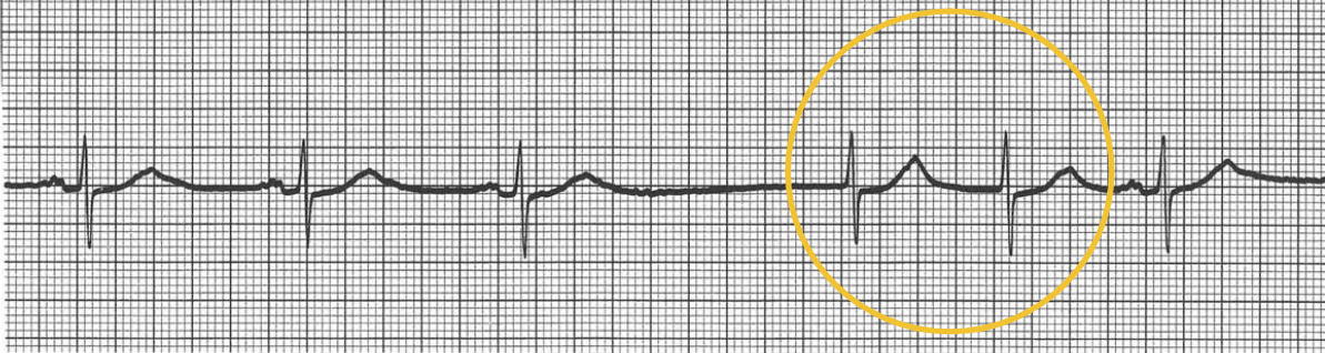 <p>near AV node</p><p>40-60 bpm</p><p>most common</p><p>may see a retrograde P wave</p><p>narrow QRS</p>