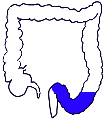 <p>sigmoid colon </p>