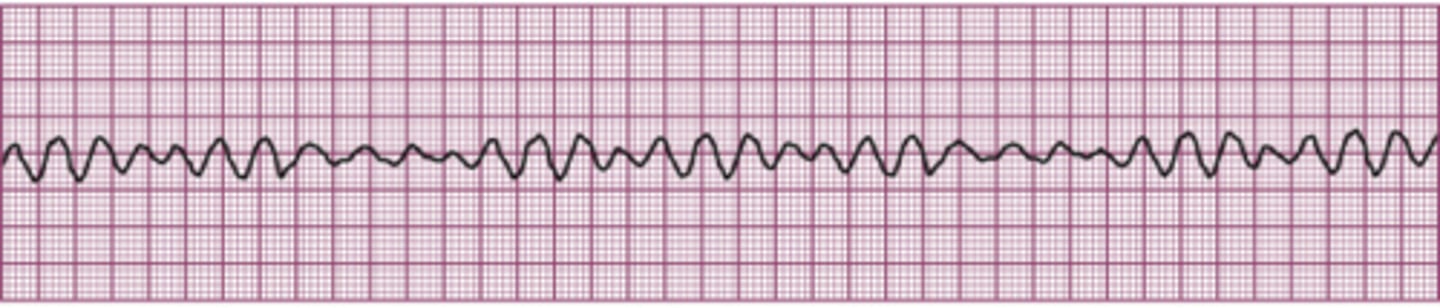 <p>A very irregular ventricular rate.</p>