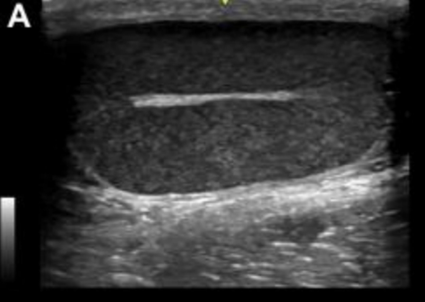 <p>What is the hyperechoic linear structure in the center?</p>