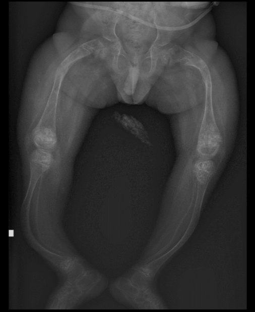 <p>what is seen here for this case of osteogenesis imperfecta?</p>