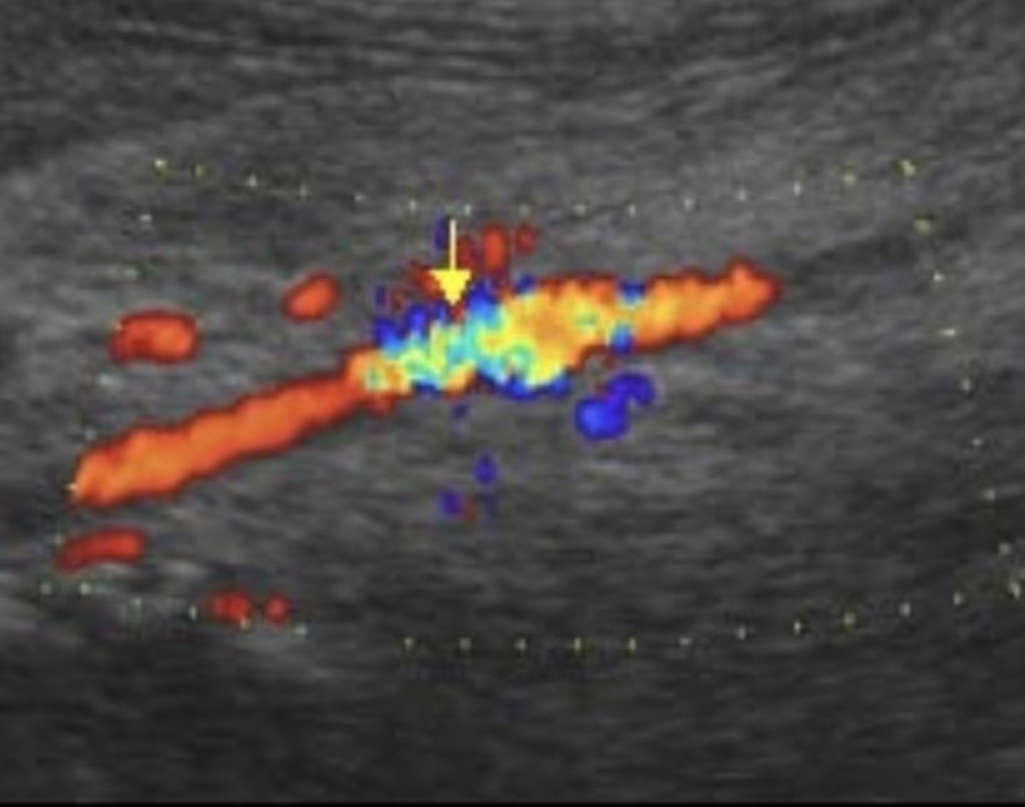 <p>High velocity jet</p><p>Distal tardus parvus flow</p>