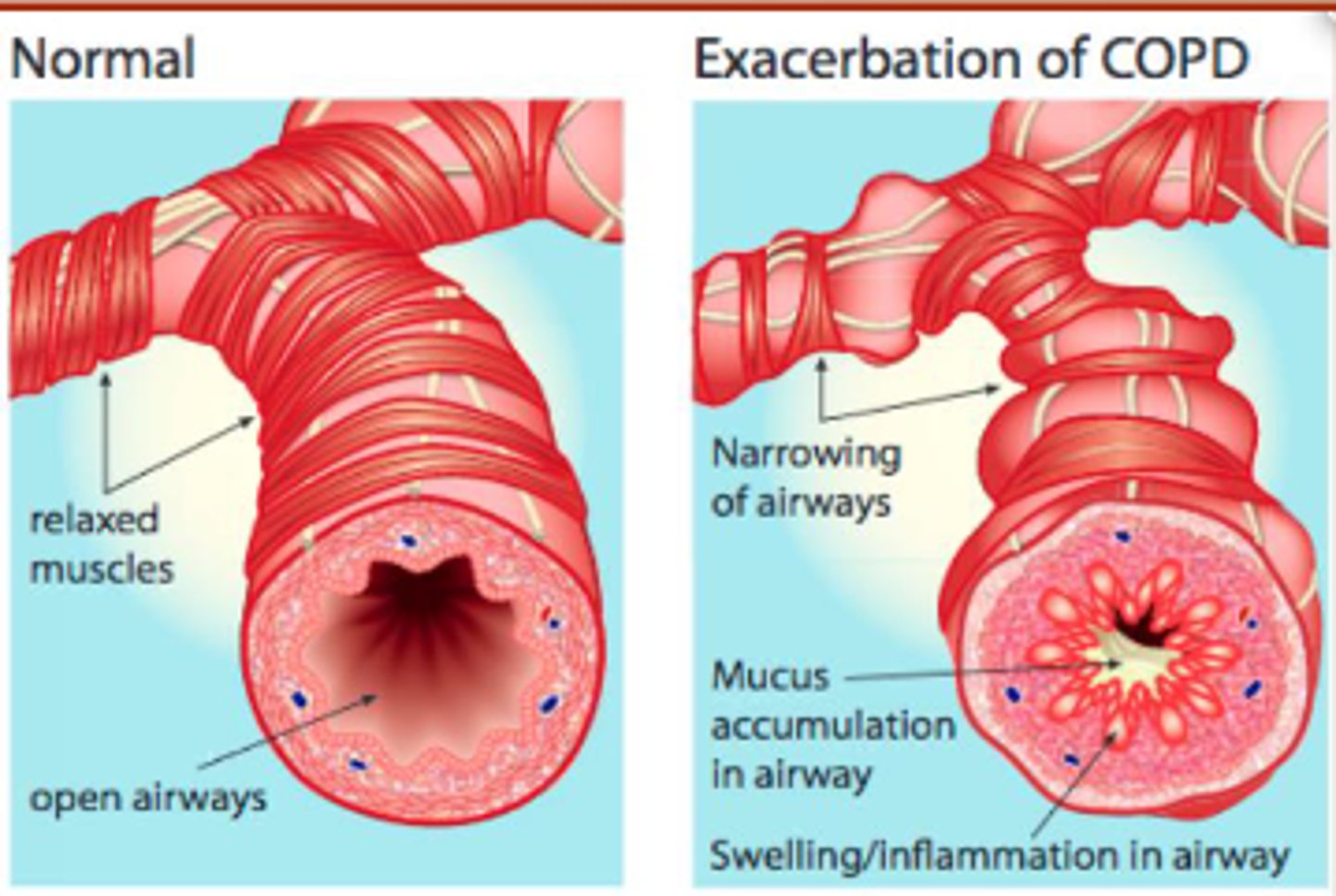 <p>- constantly irritates and inflames the lining</p><p>- leads to permanent narrowing of airways</p>