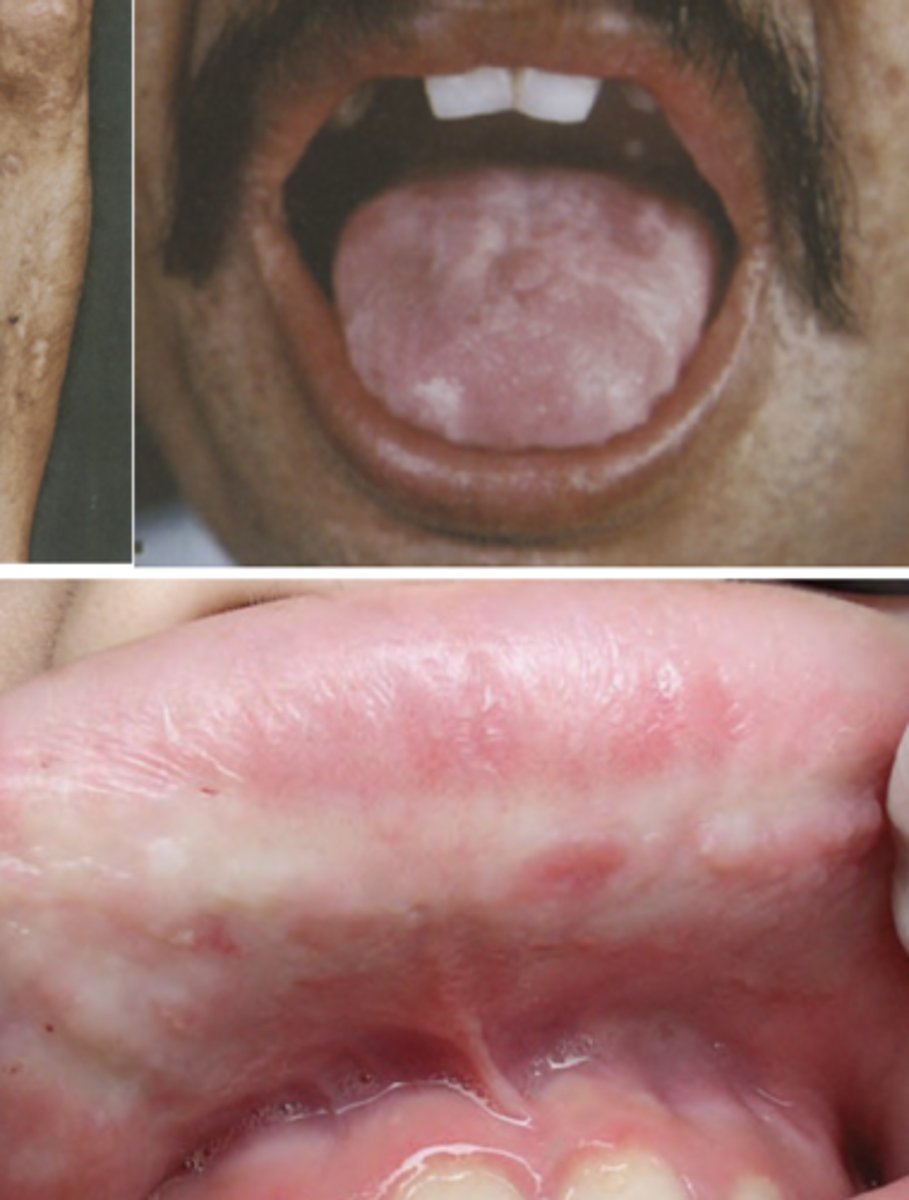 <p>-tongue, labial mucosa, and buccal mucosa: nodular, diffusely enlarged and thickened due to infiltration</p><p>-dorsal papillae destroyed -> smooth appearance of tongue</p><p>-tongue may become bound to floor of mouth</p>