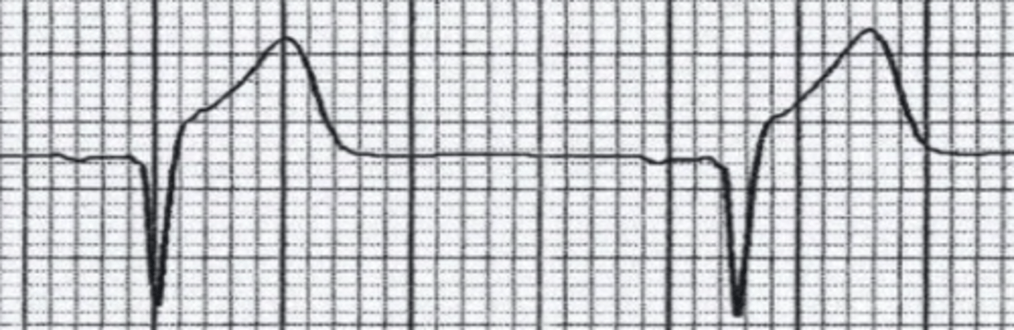 <p>- symmetrical, broad-based waves that are taller than normal</p><p>- often the earliest sign of acute ischemia</p><p>- serial EKGs should be performed</p><p>- can be first sign of impending STEMI</p><p>- may be so large that the QRS will fit inside</p>