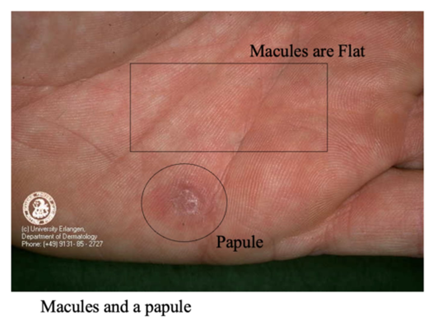 <p>Macules are flat</p><p>Papules are elevated</p>